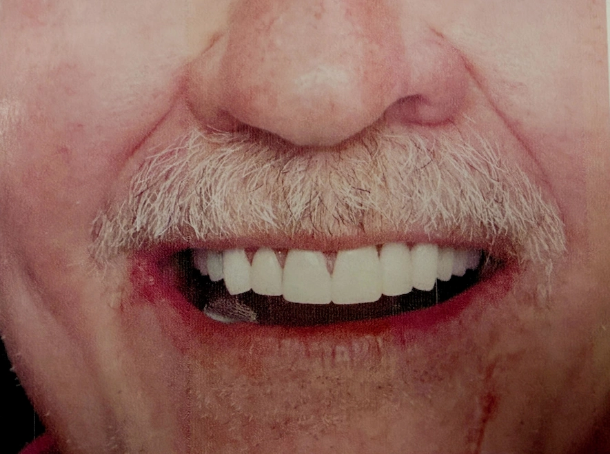 After smile makeover